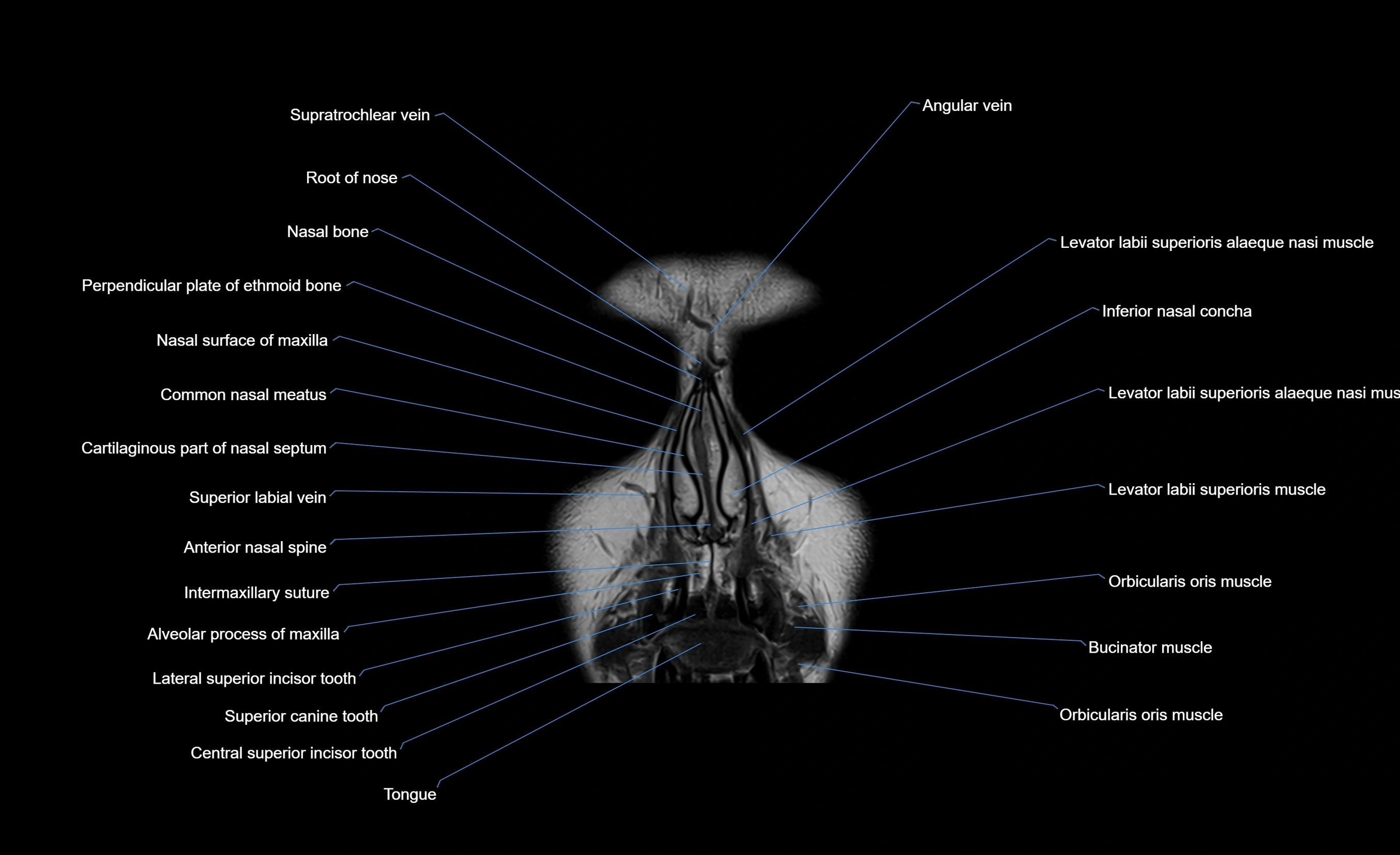 MRI face & paranasal sinuses(PNS) labelled  coronal  cross sectional anatomy 3T radiology  image-img-00001-00011.webp